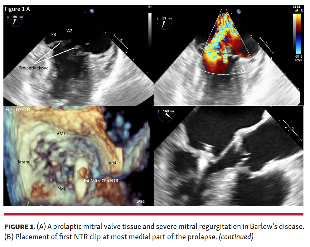Treating Mitral Valve Prolapse in Barlow’s Disease by Creation of a
